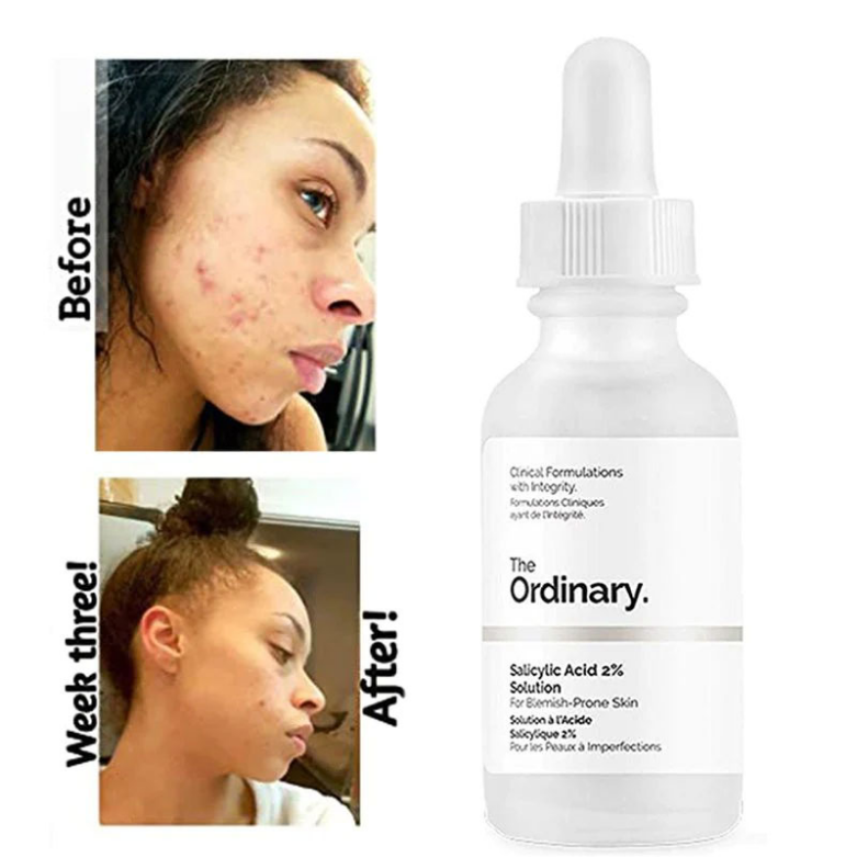 Salicylic Acid Solution 30 ml | MOQ: 30 Pcs | B072FJBVZP