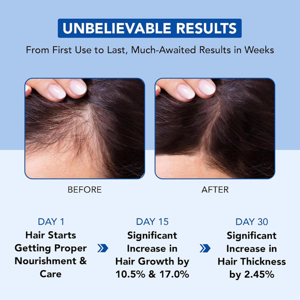 100% Pure Rosemary Oil For Hair Growth - 198 ML | MOQ 30 Pcs | B0C6XJMSGP